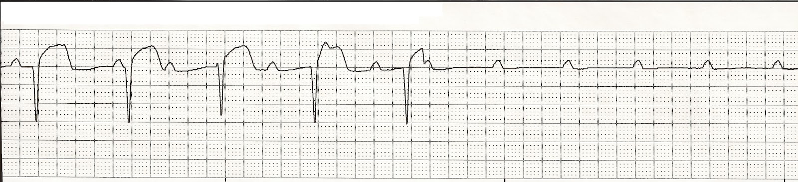 ventricular standstill strips Chimp penis spine